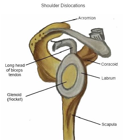 Labral Tears