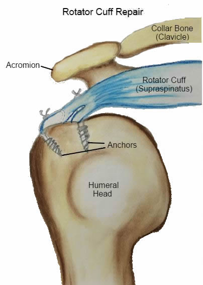 Repaired Rotator Cuff 