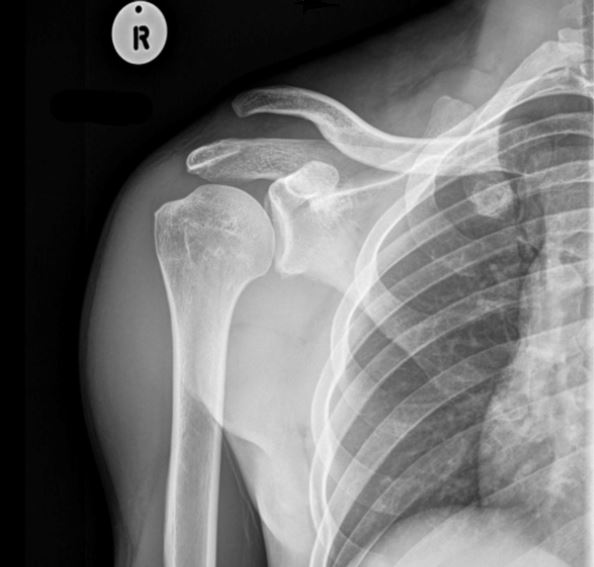 AC Joint Dislocation - scan