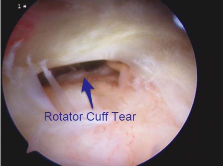 Rotator Cuff Tears