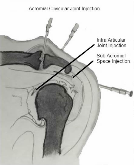 Intra-articular cortisone injections