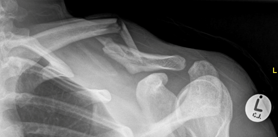 Clavicle Fractures