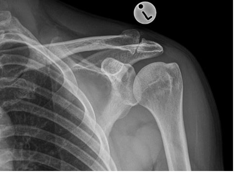 AC Joint Arthritis