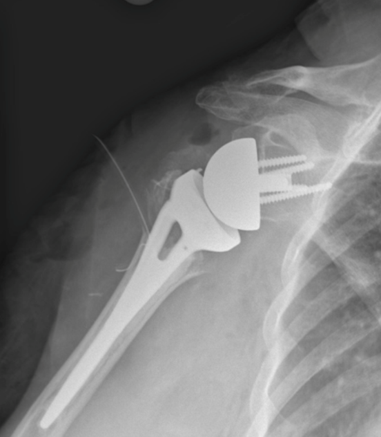 Shoulder fracture prosthesis 