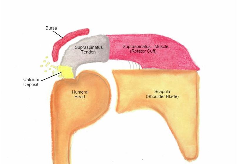 Calcific tendonitis