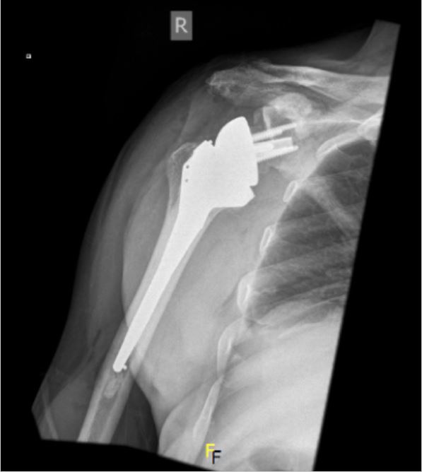 Shoulder replacement surgery