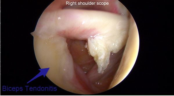 Biceps Tendonitis