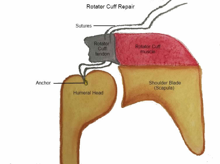 Rotator Cuff repairs