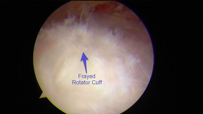  rotator cuff tear