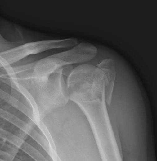 Proximal Humeral Fractures