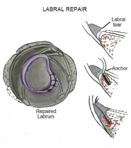 bony Bankart lesion