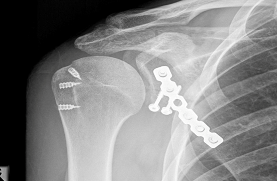 Shoulder blade fractures