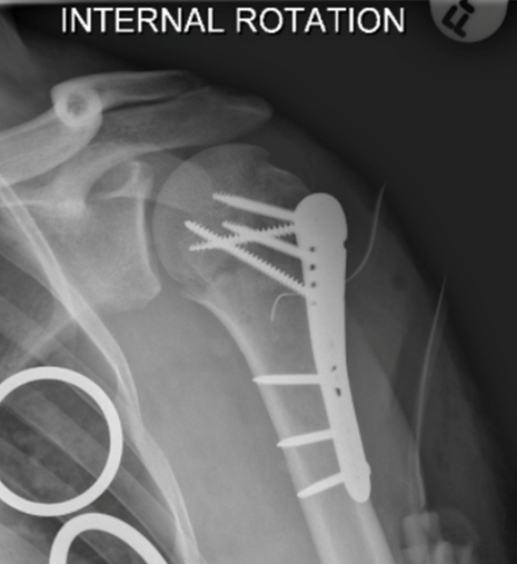 Shoulder Fracture