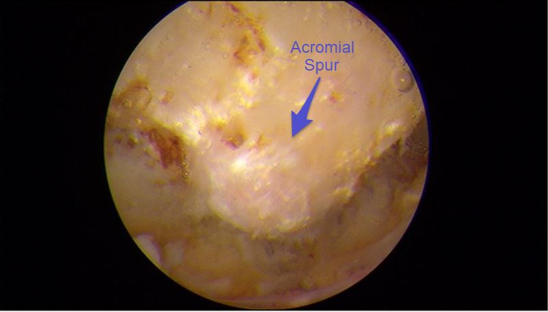  rotator cuff tear