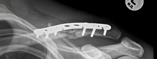  clavicle is fixed with a plate and screws