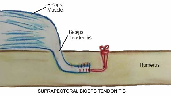 Biceps Subluxation