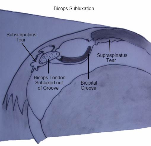 Biceps Subluxation